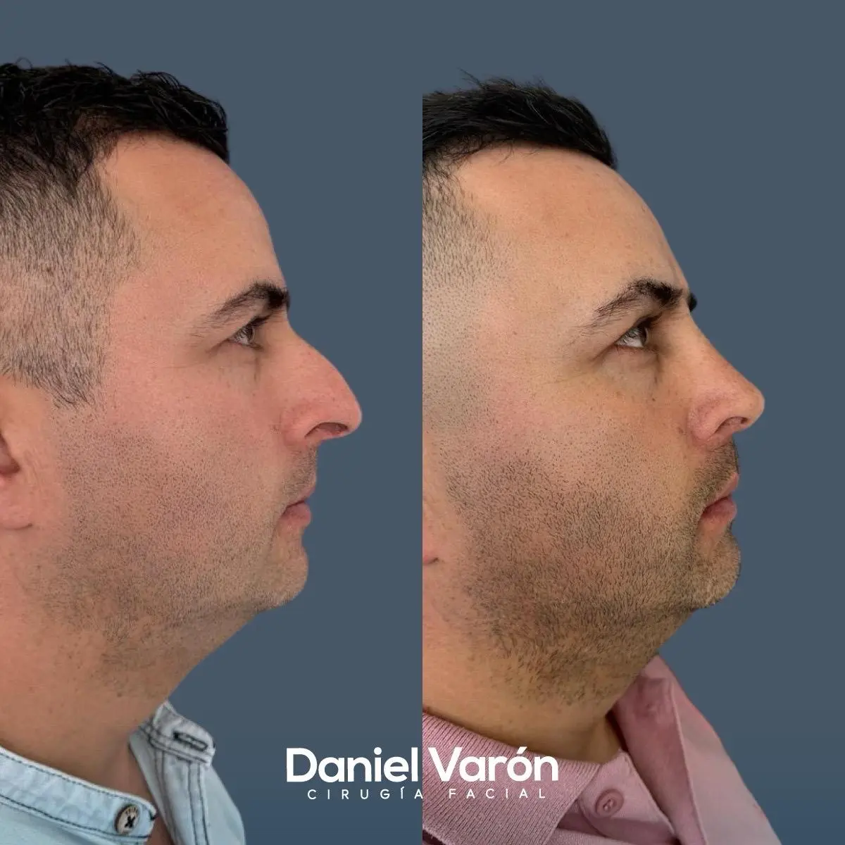 rinoplastia masculina 1