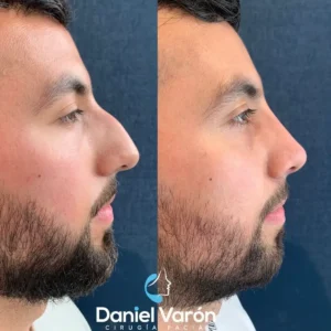 Precio de rinoplastia en manizales - dr. Daniel varón 2026 Antes-despues-rinoplastia-masculina-manizales-dr-daniel-varon-08. Jpg