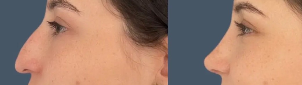 RINOPLASTIA FEMENINA