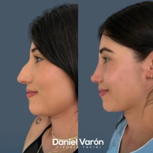 Rinoplastia femenina antes y despues